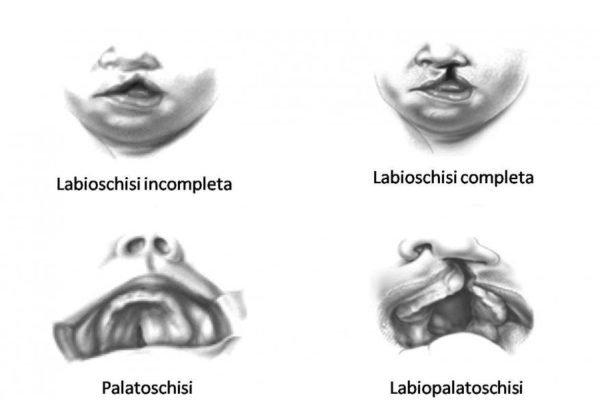Labioschisi (labbro leporino), palatoschisi e labiopalatoschisi: consigli e chiarimenti.