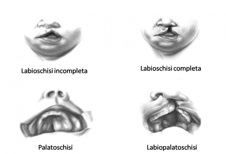 Al momento stai visualizzando Labioschisi (labbro leporino), palatoschisi e labiopalatoschisi: consigli e chiarimenti.