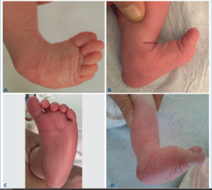 Illustrazione delle principali malformazioni da piede torto nel neonato